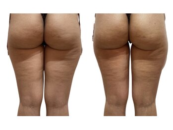 痩せラボ/内太腿の集中【痩身】