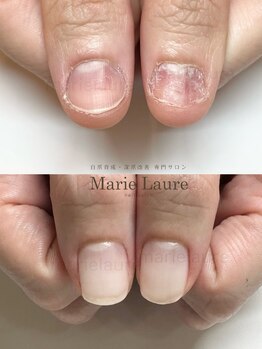 マリーロール 淀屋橋本店(Marie Laure)/自爪育成/深爪矯正/ネイルケア