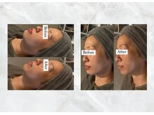 ロイズ(LOYS)/サーマトリックス