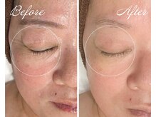 AK エステティックス(AK Esthetics)/目元のシワケアはプラズマで★