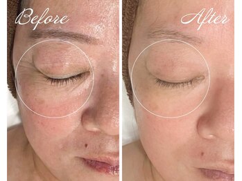 AK エステティックス(AK Esthetics)/目元のシワケアはプラズマで★