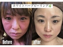 ウィズハーヴェ(w/haave)/敏感肌　ハーブピーリング