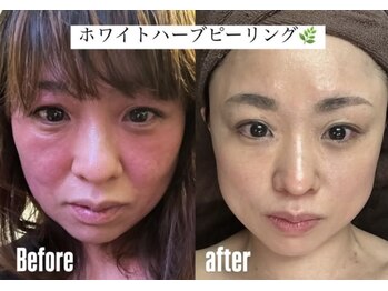 ウィズハーヴェ(w/haave)/敏感肌 ハーブピーリング