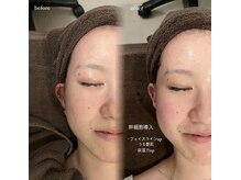 アンド バイ ビューティー(& by beauty)/幹細胞導入【担当:hana】