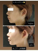 チャルム(CAL'ME)/レモンボトル・あご下