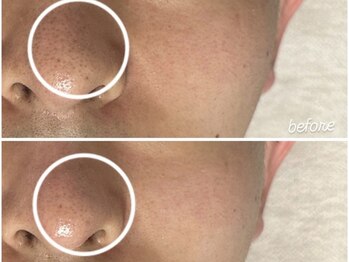 アンリミット 鹿児島天文館店(Une limit)/表面上の黒ずみ気になる方