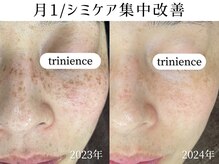細かいシミケアもお任せ！レーザーとは違いお肌に優しい施時♪