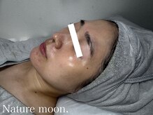 ナチュールムーン(Nature moon.)/ハーブピーリング after