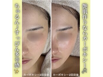 ハニエル(Haniel)/カーボキシー症例