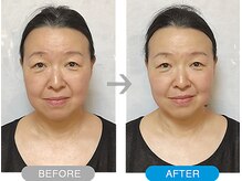 ワト(WATO)/■小顔施術（before→after)