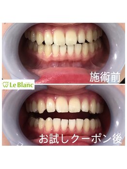 ルブラン 奈良店(Le Blanc)/黄ばみぶっ飛ばそう!!