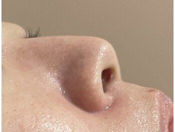 アンドユー ヨコハマ(&U Yokohama)/クリスティーナ施術1回後