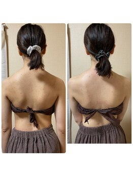 スリーピングビューティー(Sleeping Beauty)/インディバ　肩の盛り上がり改善