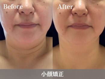 RHB東戸塚/小顔エステはRHB東戸塚