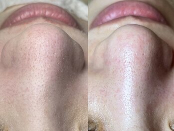 エヌエクラ(N.eclat.)/鼻