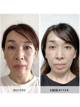 サロン レインボー(SALON RAINBOW)/小顔集中コース Before/After