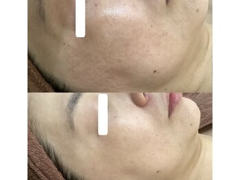 ロゼブランシュ(Rose Blanche)/シミケアにはテキメン!