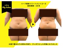 イエス マイサロン(yes My Salon)/ハーフ痩身トリートメント症例