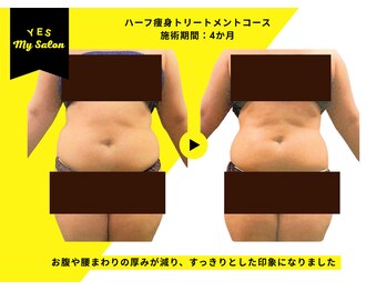 イエス マイサロン(yes My Salon)/ハーフ痩身トリートメント症例