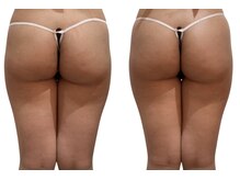 痩せラボ/お尻引き上げ【痩身】