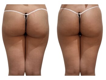 痩せラボ/お尻引き上げ【痩身】