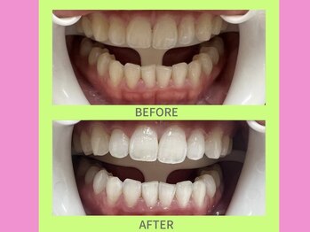 ココティ ホワイトニング(Cocotii)/お客様ビフォーアフター