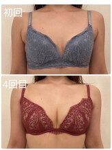 美人バスト 町田店/バストアップ◇症例◇