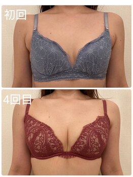 美人バスト 町田店/バストアップ◇症例◇