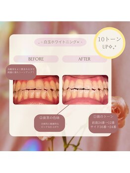 プラスビーセルフ(+b self)/ホワイトニングビフォーアフター