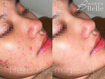 ベル 札幌(Belle)/ハーブピーリング｜毛穴ケア