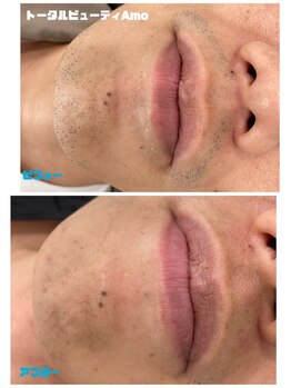 アモ(amo)/髭脱毛ビフォーアフター