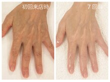 キレイテ 福岡天神店/シワ・ハリのなさ、血管浮き