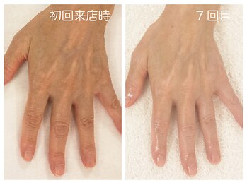 キレイテ 福岡天神店/シワ・ハリのなさ、血管浮き