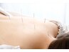 【鍼】【美容鍼90分】体の症状・たるみ改善☆美容鍼+全身鍼90分フルケア