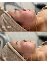 アルフォービューティー 難波店(ALU for beauty)/オンダリフト症例