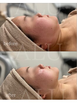 アルフォービューティー 難波店(ALU for beauty)/オンダリフト症例