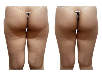 痩せラボ/むくみ撃退！【痩身】