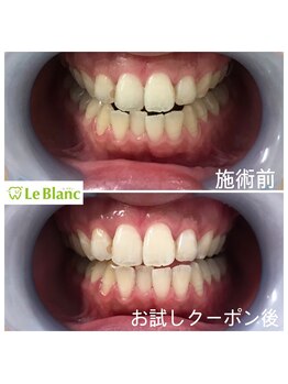 ルブラン 奈良店(Le Blanc)/効果実感できる