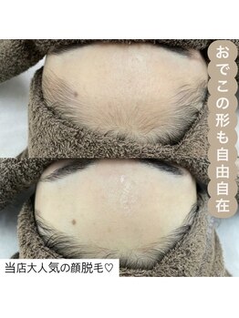カルディエ(Cardie)/おでこ脱毛　ビフォーアフター