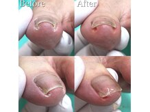 巻き爪補正店 町田店/～巻き爪補正～