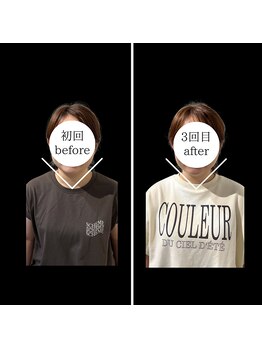 トイ鍼灸接骨院(TOY鍼灸接骨院)/●美容鍼