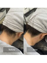 凰湖/うなじ脱毛