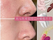 リ ミュール(Ri.miyuru)の雰囲気（夏に気になる毛穴の開き/内側からふっくら・キュッと締まる◎）