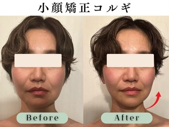 スイスパ(翠SUI SPA)/【小顔矯正コルギ】Before/After