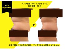 イエス マイサロン(yes My Salon)/ハーフ痩身トリートメント症例