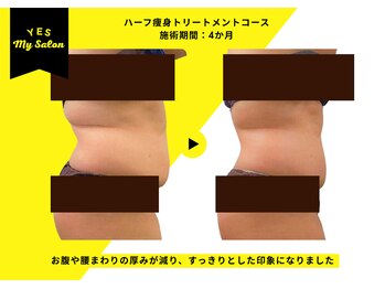 イエス マイサロン(yes My Salon)/ハーフ痩身トリートメント症例