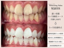 ホワイト(WHITE)/通い放題5ヶ月継続コース★WHITE
