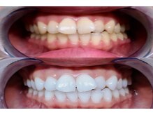 ライトケアサロン 表参道店(Light Care Salon)/効果抜群♪最新ホワイトニング☆