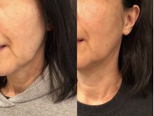 はる鍼灸整骨院/ほうれい線を薄く＋肌ツヤUP！