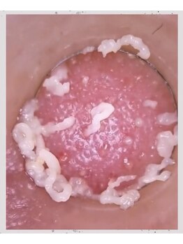 メルディアナ(MAR DIANA)/クリスタル毛穴洗浄